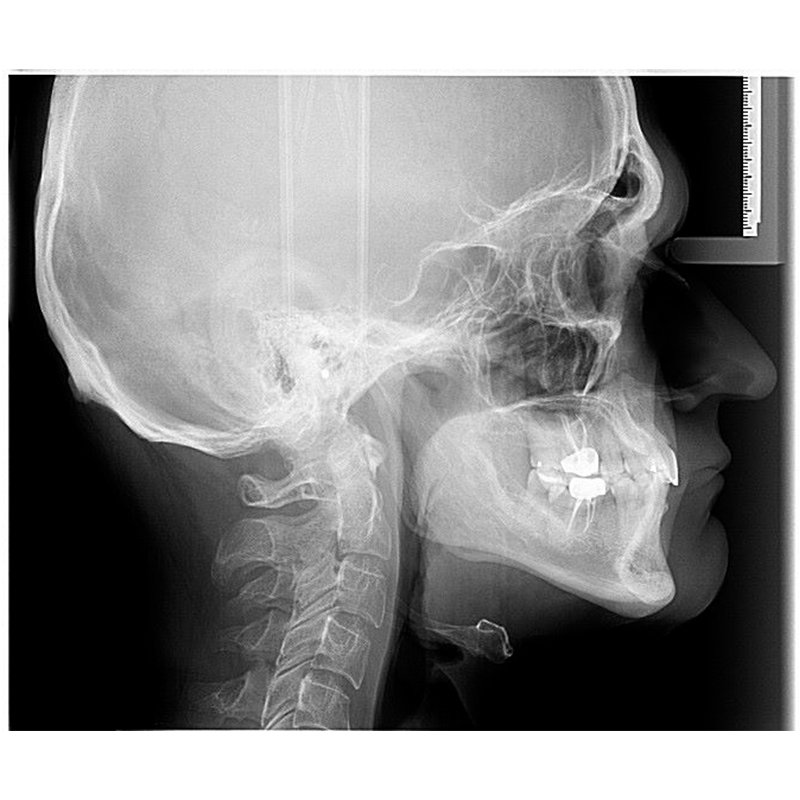 radiografia lateral de craneo en queretaro zibata