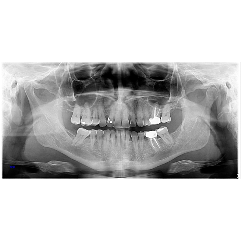 radiografia panoramica dental en queretaro zibata